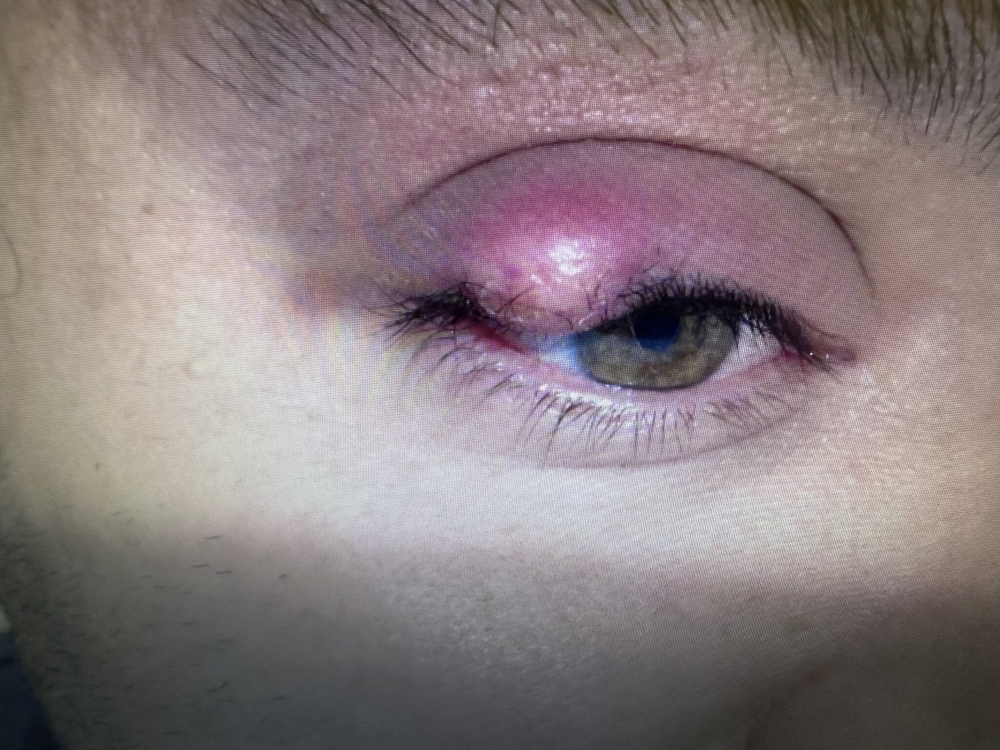 Excision of Lesion Eye Before