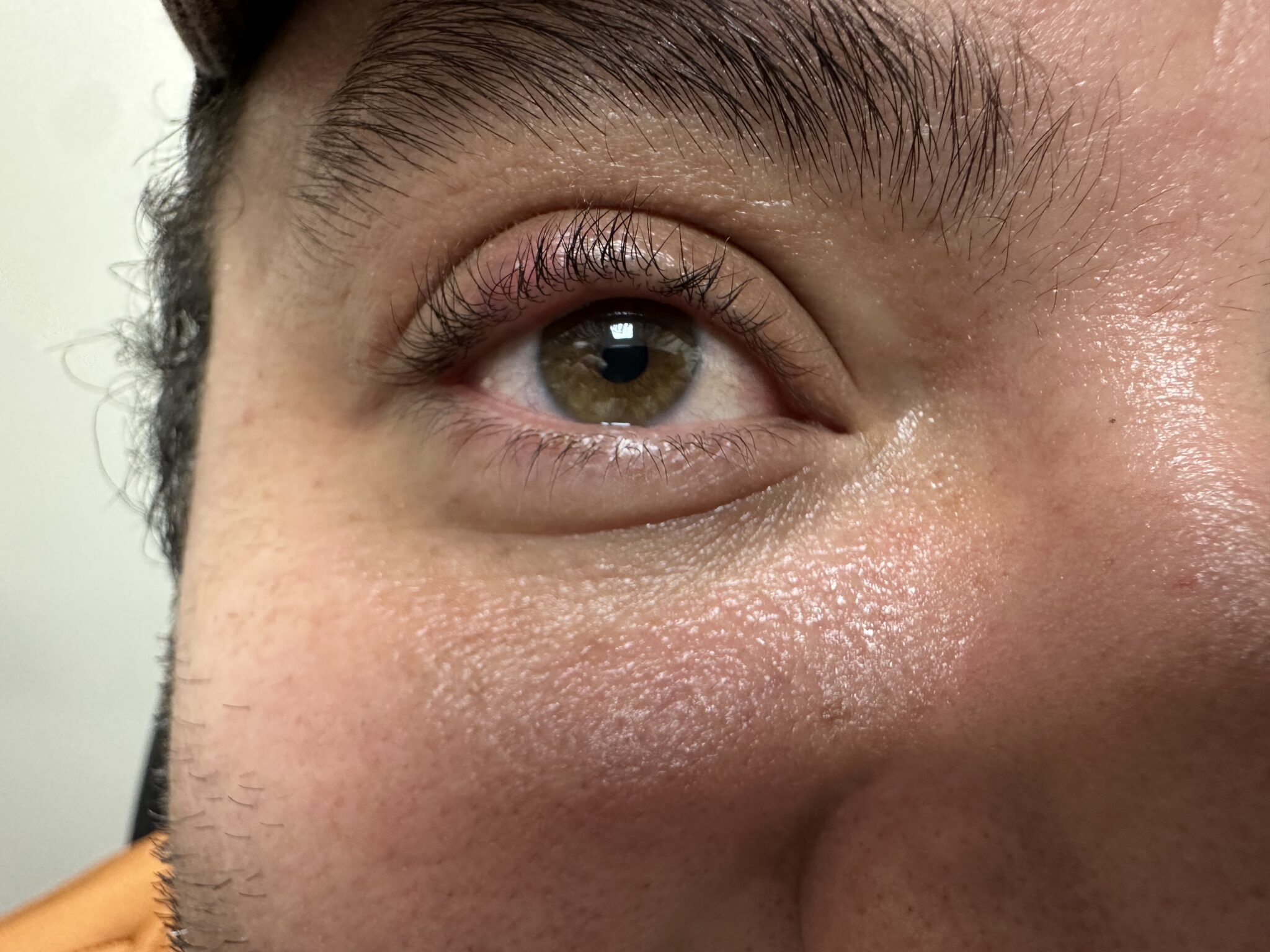 Excision of Lesion Eye After