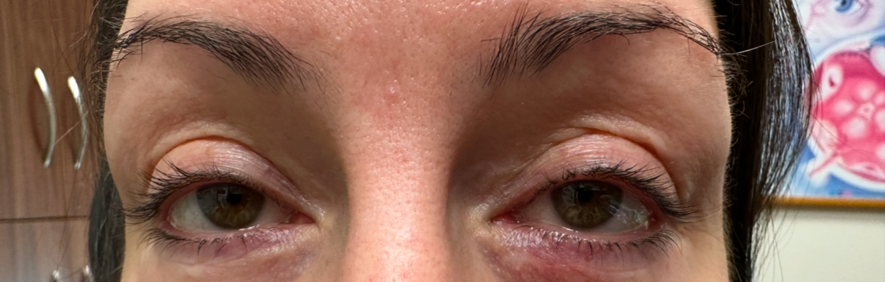 Upper and Lower Eyelid Cosmetic Blepharoplasty and Brow Lift Both Eyes After