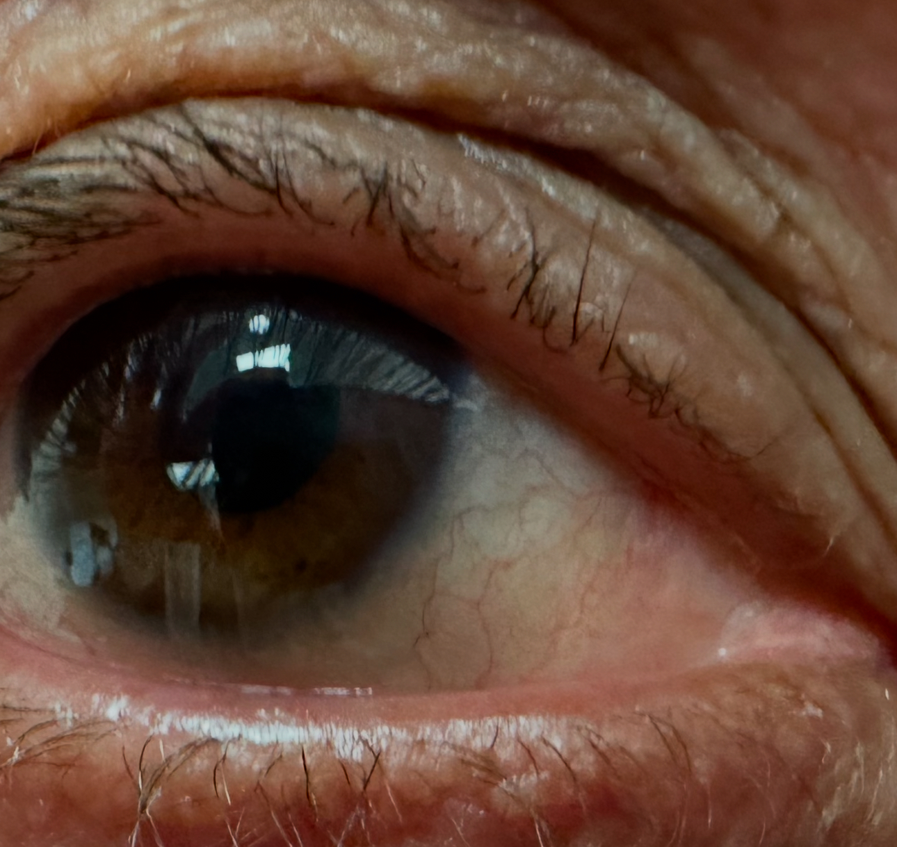 Pterygium Excision and Placement of Amniotic Membrane Graft After