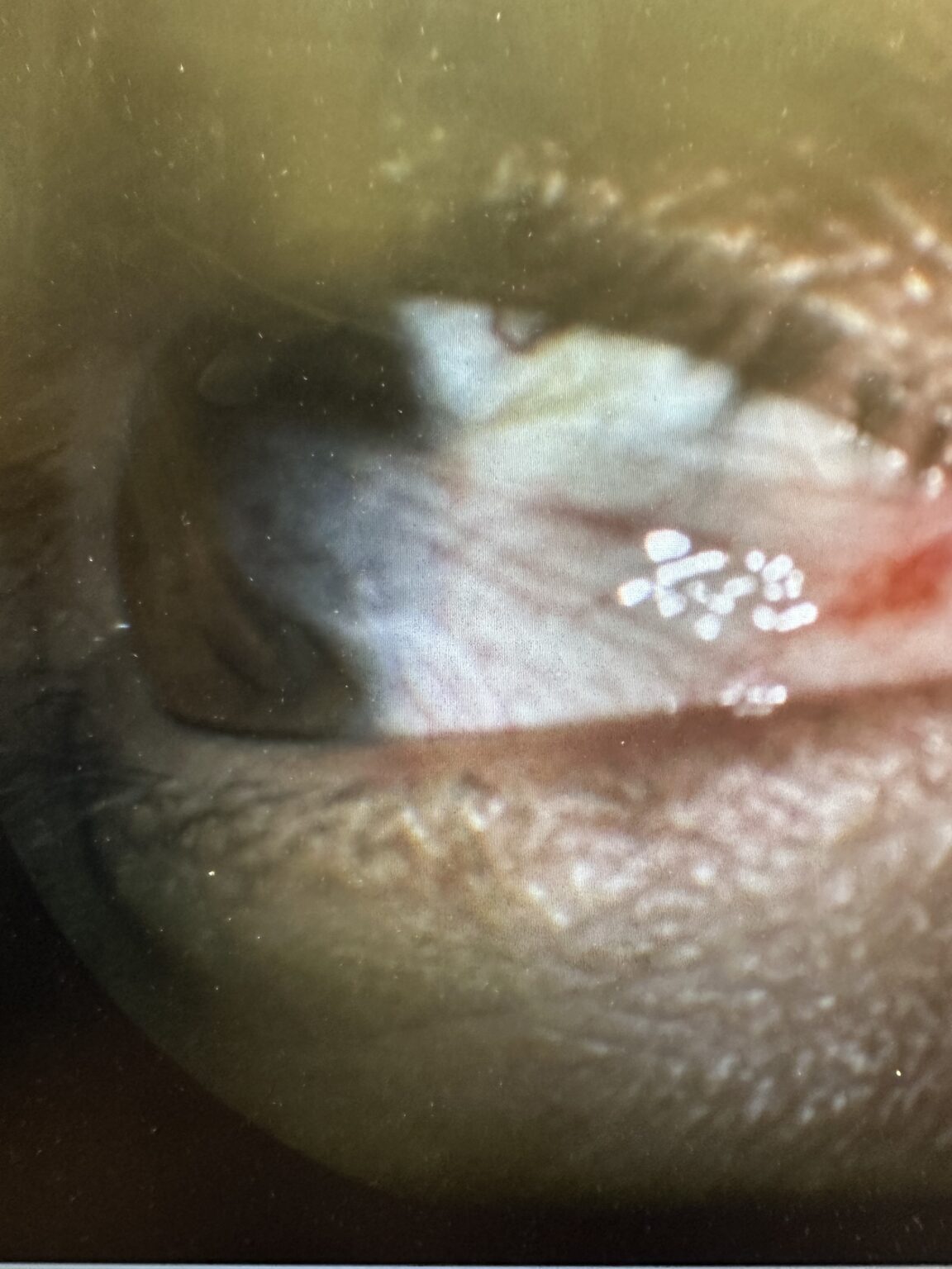 Pterygium Excision and Placement of Amniotic Membrane Graft Before