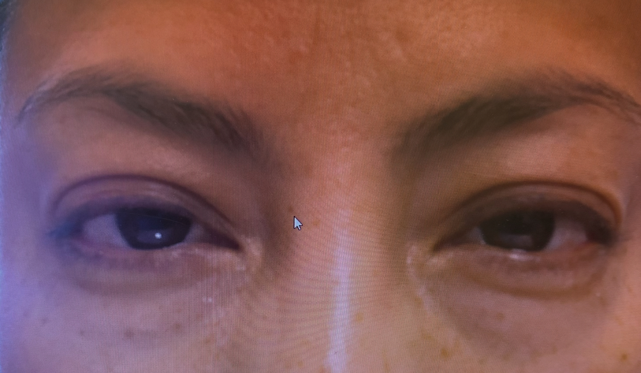 Ptosis Repair Blepharoplasty both Upper Lids Before