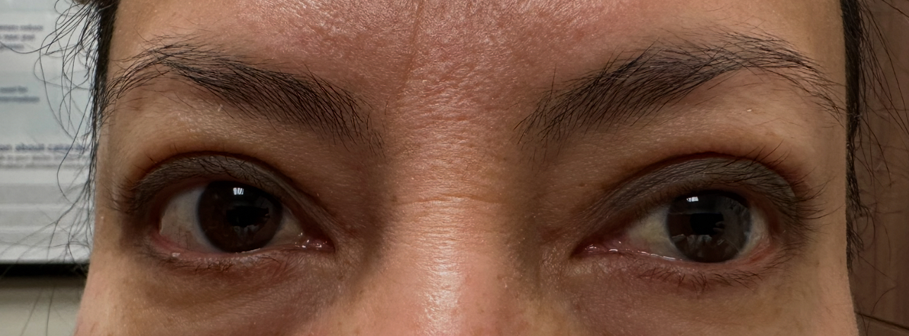 Ptosis Repair Blepharoplasty both Upper Lids After