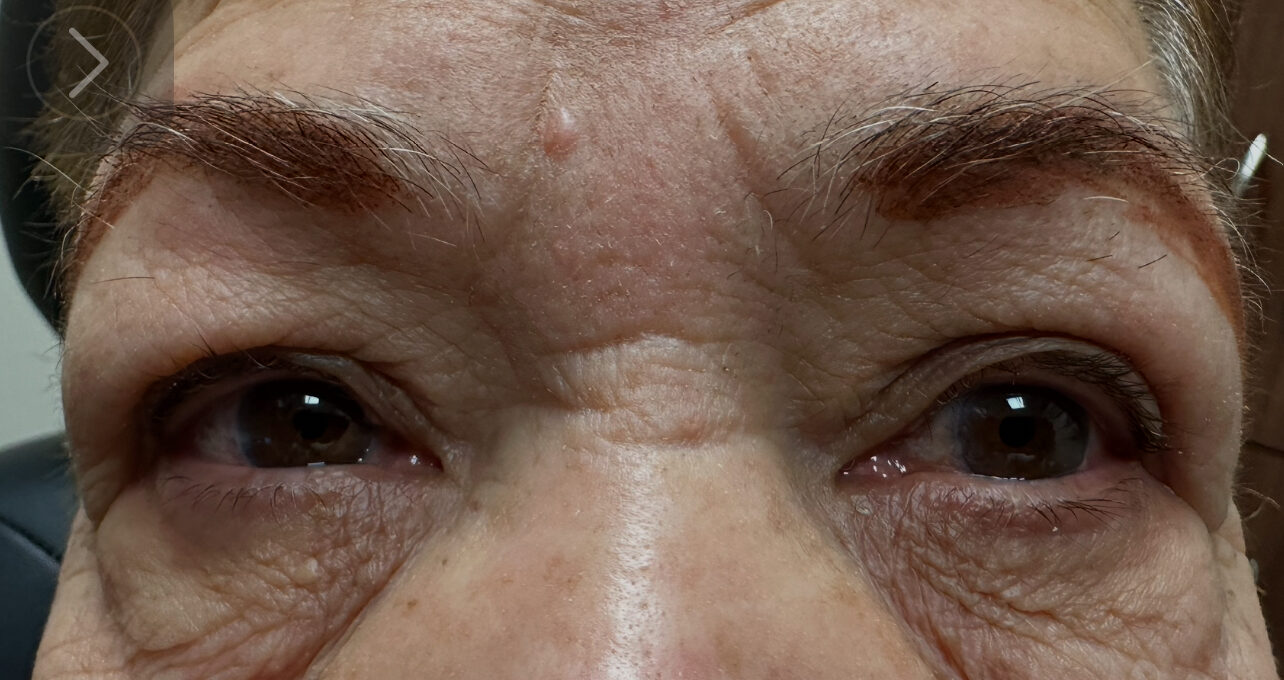 Ptosis repair for both the right and left upper eyelids, along with Upper Blepharoplasty for the eyelids on both sides, and Browpexy/Brow lift on the right and left brows After