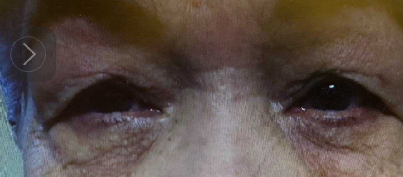 Ptosis repair for both the right and left upper eyelids, along with Upper Blepharoplasty for the eyelids on both sides, and Browpexy/Brow lift on the right and left brows Before
