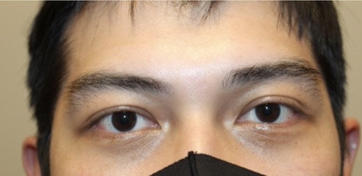 Cosmetic Lower Blepharoplasty After