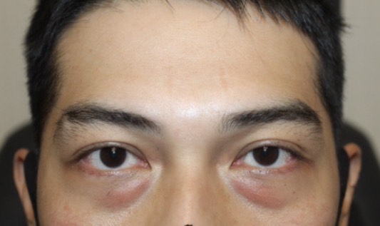 Cosmetic Lower Blepharoplasty Before