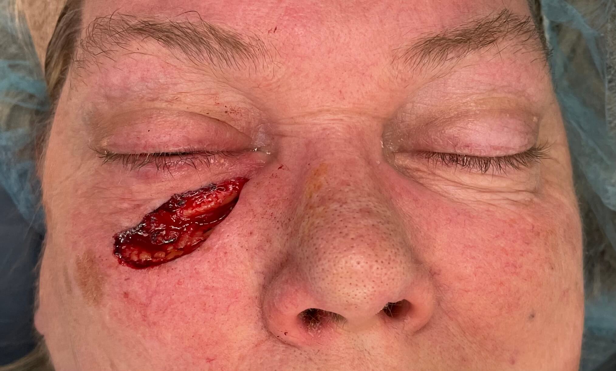 Eyelid Reconstruction After Skin Cancer After Mohs Excision
