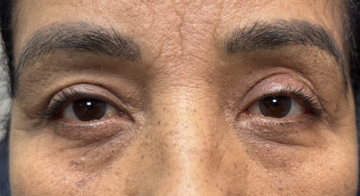 Lid Ptosis & Brow Ptosis Surgery After