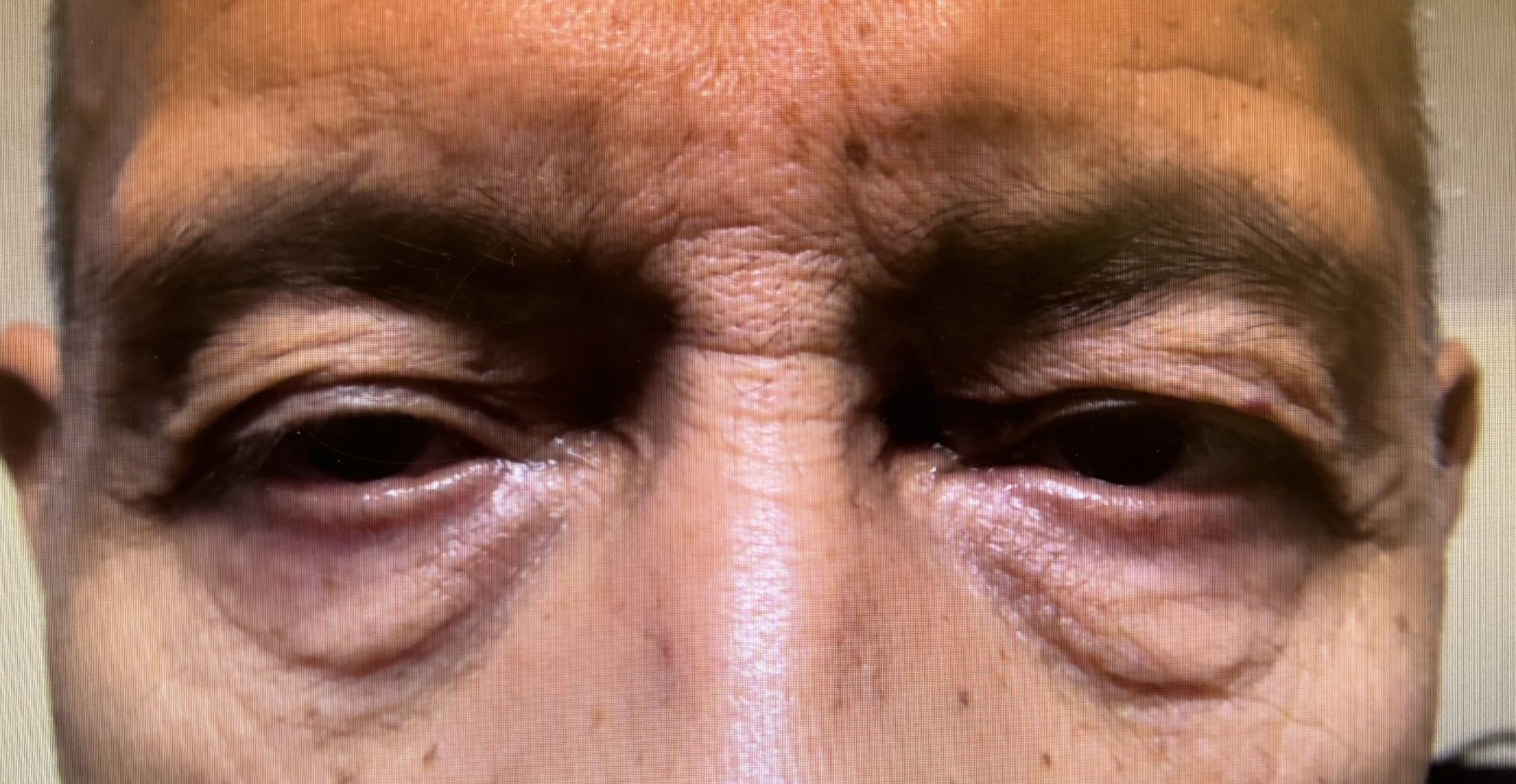 Lid Ptosis & Brow Ptosis Surgery Before