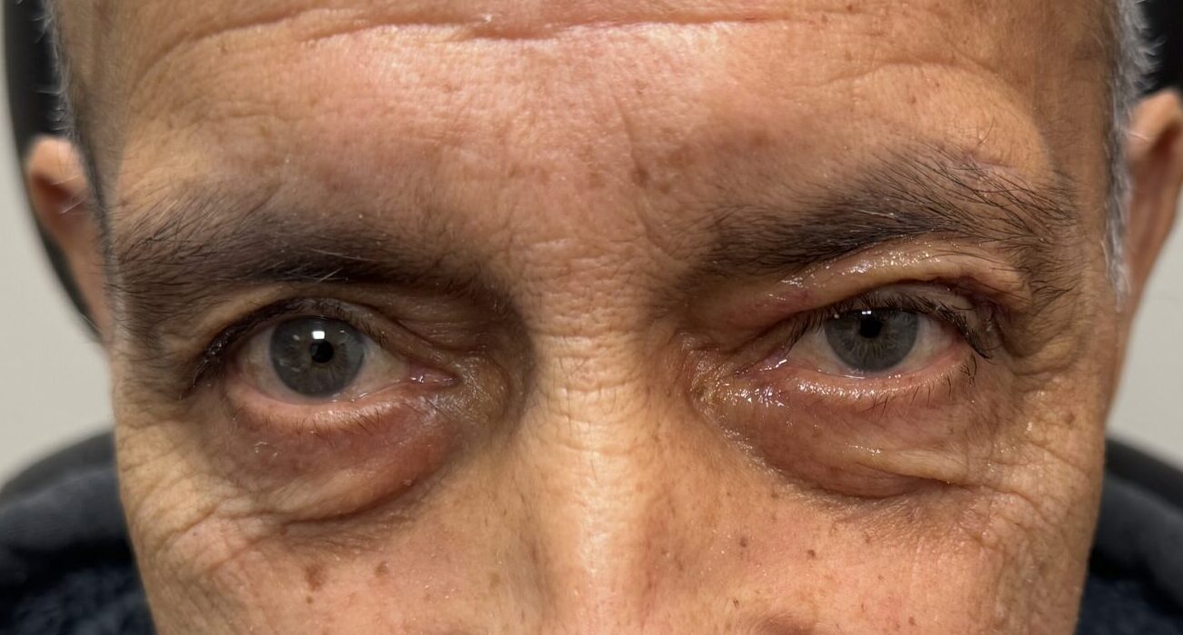 Lid Ptosis & Brow Ptosis Surgery After