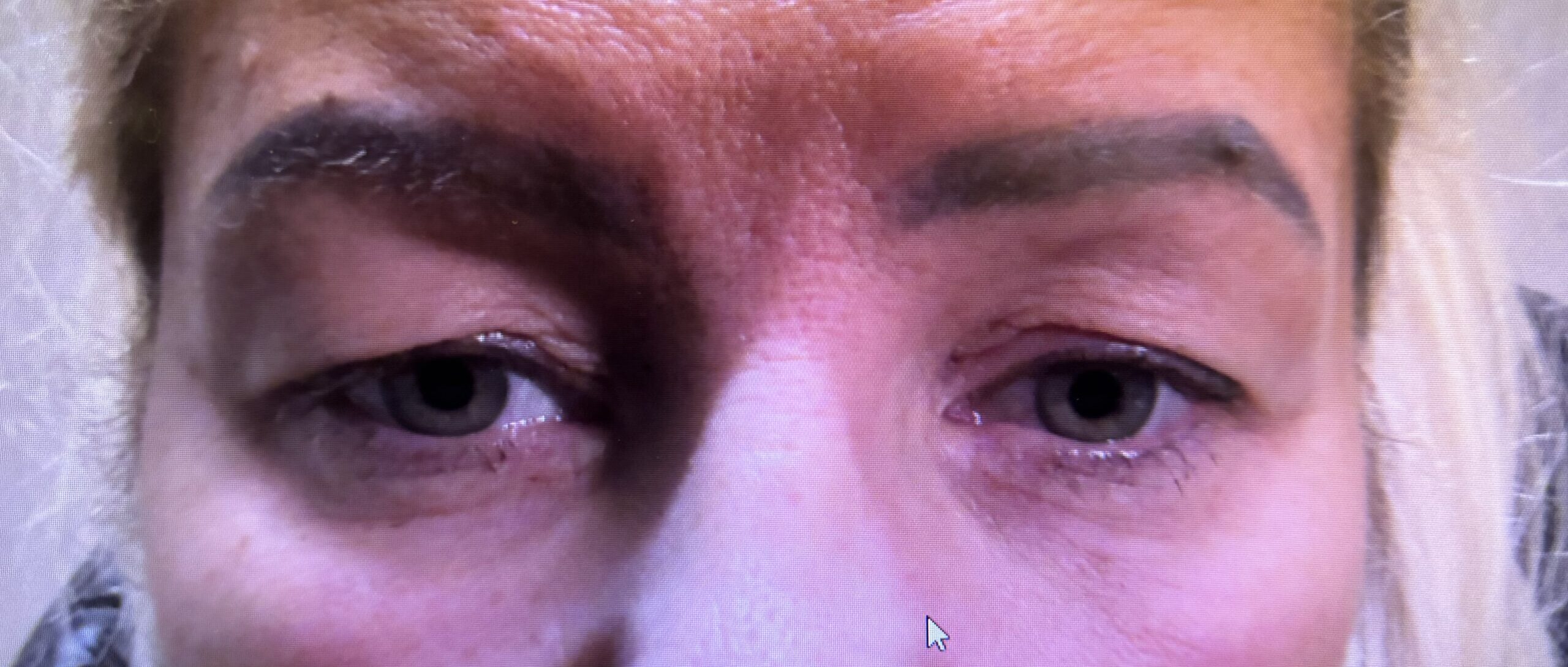 Ptosis & Brow Repair Before