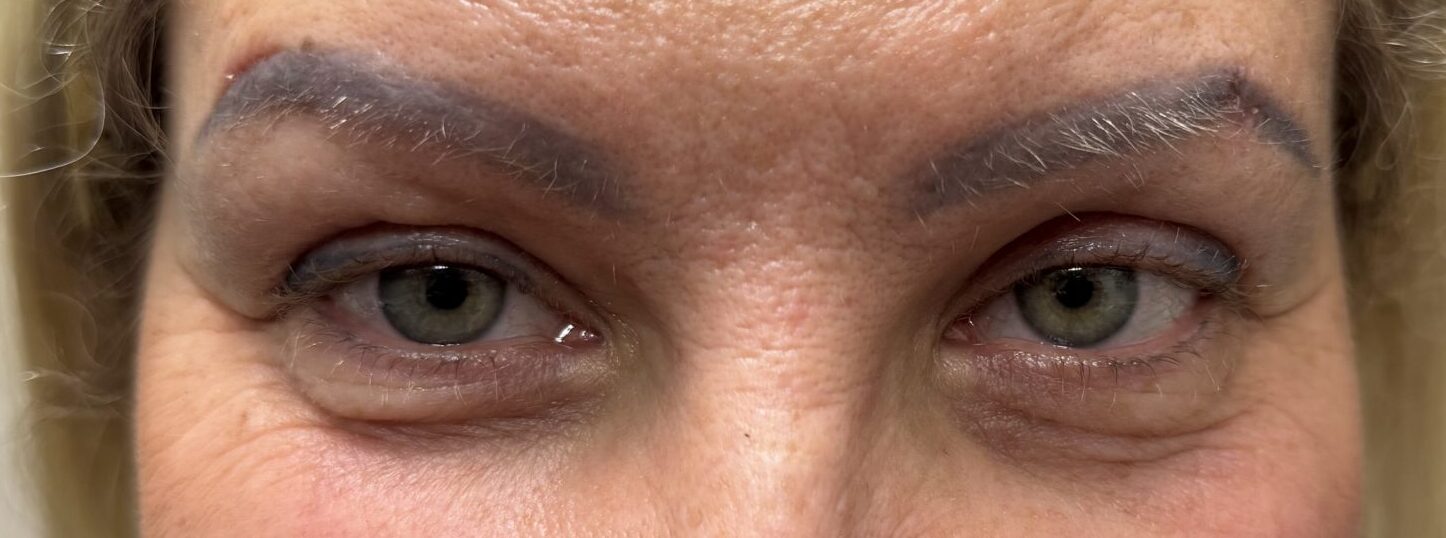 Ptosis & Brow Repair After
