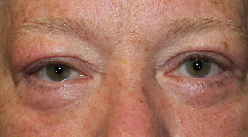 BUL/BLL Blepharoplasty (with skin removal) (Post-Operative Month 3) After