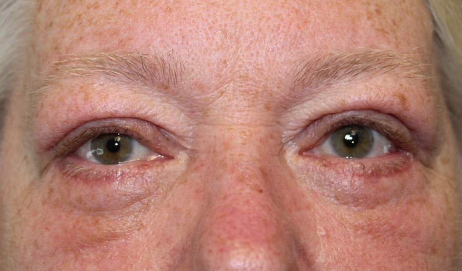 BUL/BLL Blepharoplasty (with skin removal) (Post-Operative Month 1) After