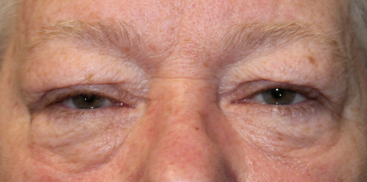 BUL/BLL Blepharoplasty (with skin removal) (Post-Operative Month 1) Before