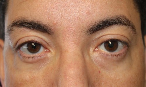 Lower Blepharoplasty After