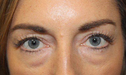 Upper & Lower Blepharoplasty Before