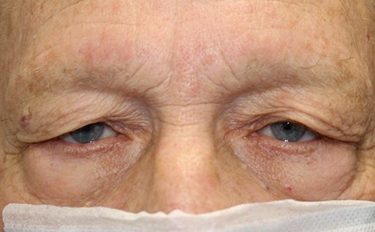 Direct Brow Ptosis Repair and Blepharoplasty Before