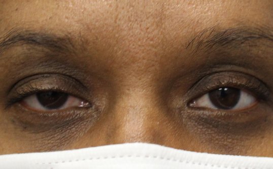 Bilateral Internal Ptosis Repair Before