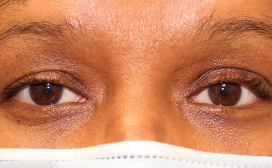 Bilateral Internal Ptosis Repair After