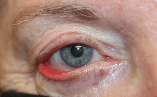 Ectropion Repair Before