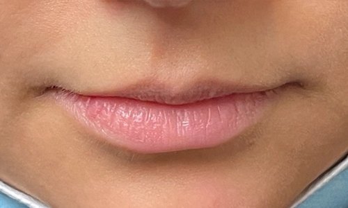 Lip Filler Treatment Before