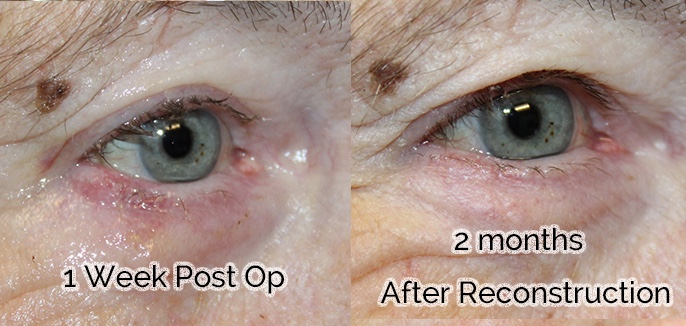 Basal Cell Carcinoma Requiring Full Thickness Wedge Reconstruction