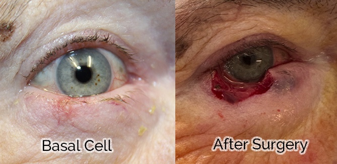 Basal Cell Carcinoma Requiring Full Thickness Wedge Reconstruction