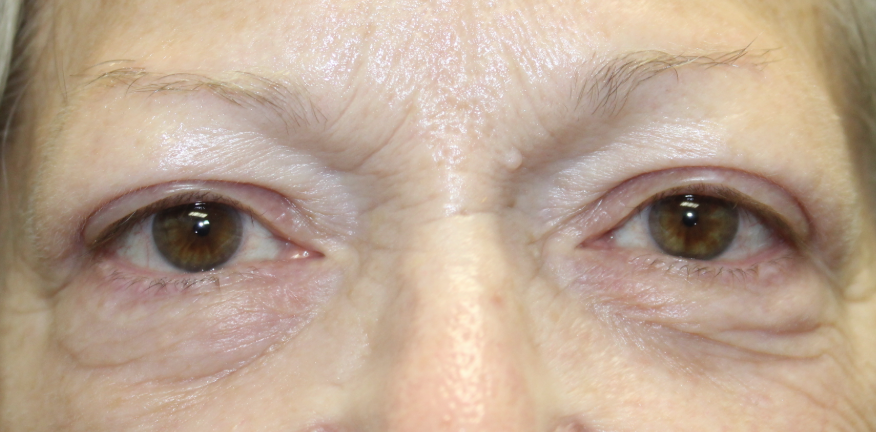 Bilateral Upper Eyelid Blepharoplasty (Post-Operative Month 3) After