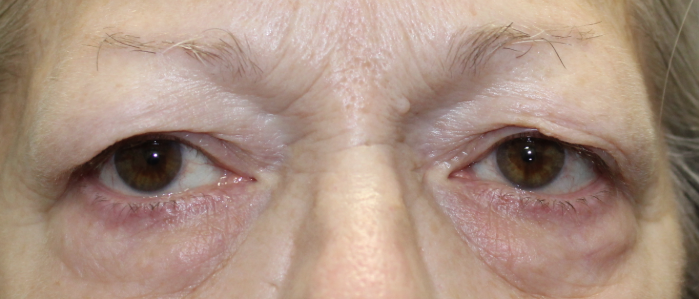 Bilateral Upper Eyelid Blepharoplasty (Post-Operative Month 3) Before