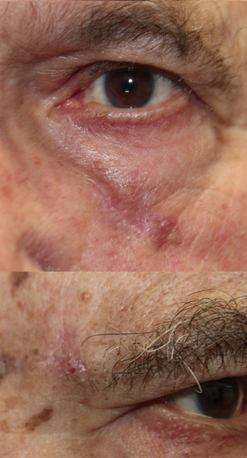 Right Brow (1) and Left Lower Lid (2) Lesion Removal (Seborrheic Keratosis) (Postoperative Week 2) After