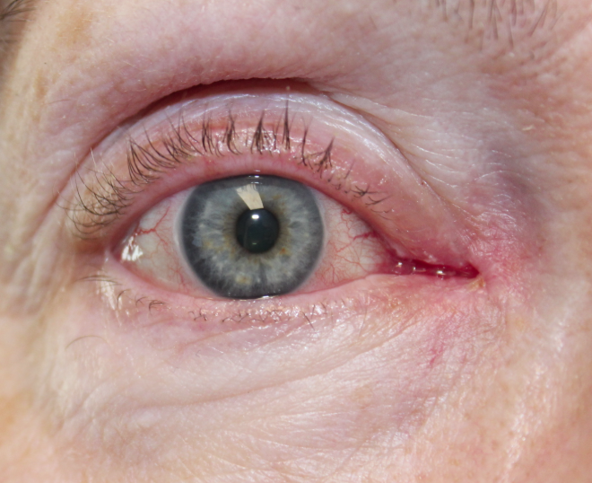 Eyelid Cyst Removal (Post-Operative Week 1) After