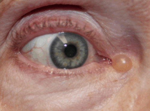 Eyelid Cyst Removal (Post-Operative Week 1) Before