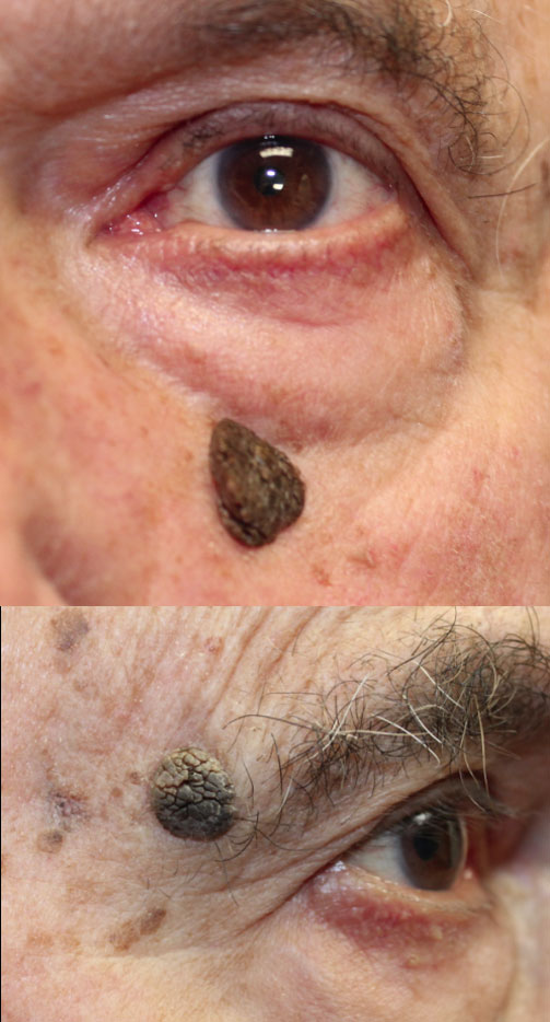 Right Brow (1) and Left Lower Lid (2) Lesion Removal (Seborrheic Keratosis) (Postoperative Week 2) Before