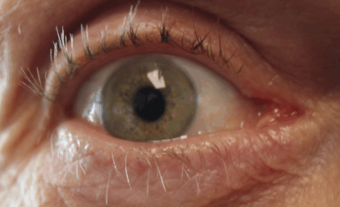 Squamous Papilloma on RUL/caruncle (Post-Operative Week 1) After