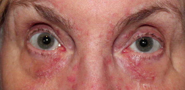 Bilateral Upper & Lower Eyelid Lesion (Xanthelasma) Removal - (Post-Operative Week 1) After