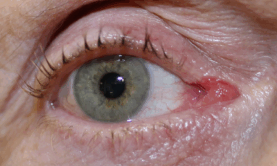 Squamous Papilloma on RUL/caruncle (Post-Operative Week 1) Before