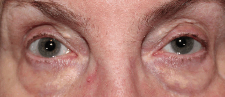 Bilateral Upper & Lower Eyelid Lesion (Xanthelasma) Removal - (Post-Operative Week 1) Before