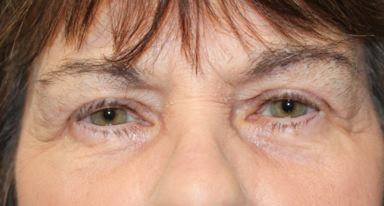Bilateral Upper & Lower Eyelid Blepharoplasty with C02 Laser Resurfacing (Postoperative Month 1) After