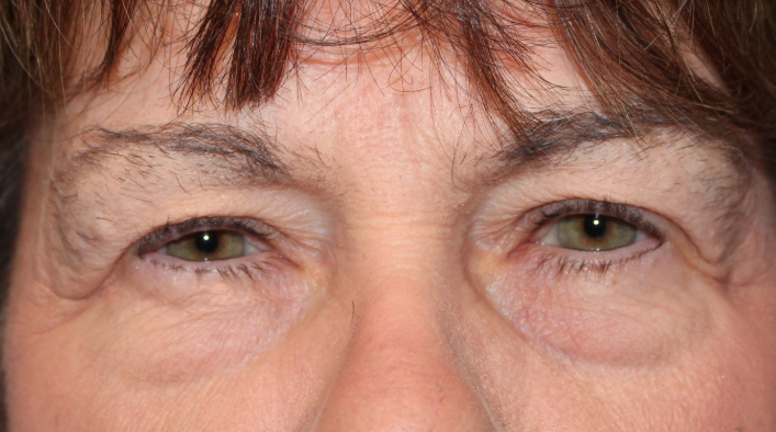 Bilateral Upper & Lower Eyelid Blepharoplasty with C02 Laser Resurfacing (Postoperative Month 1) Before