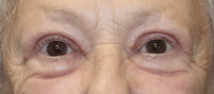 Bilateral Upper & Lower Eyelid Blepharoplasty with C02 Laser Resurfacing (Postoperative Month 1) After