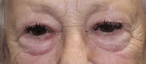 Bilateral Upper & Lower Eyelid Blepharoplasty with C02 Laser Resurfacing (Postoperative Month 1) Before
