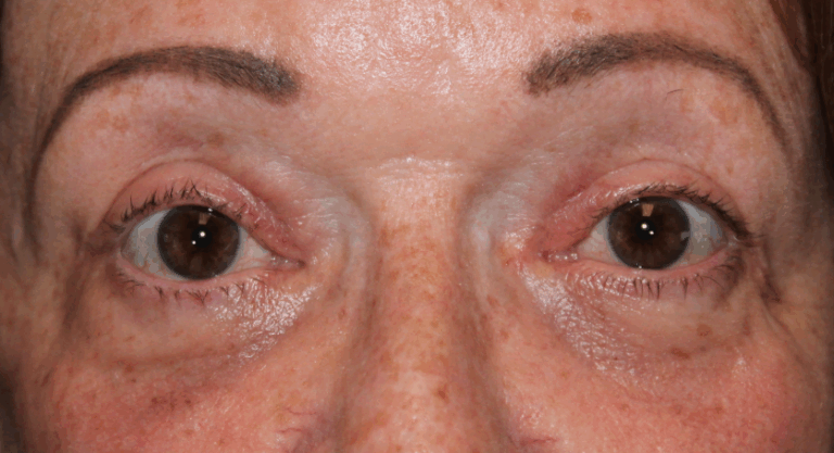 Bilateral Upper & Lower Eyelid Blepharoplasty with C02 Laser Resurfacing (Postoperative Week 6) After