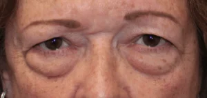 Bilateral Upper & Lower Eyelid Blepharoplasty with C02 Laser Resurfacing (Postoperative Week 6) Before