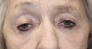Bilateral Upper Eyelid Ptosis Repair, Bilateral Lower Eyelid Blepharoplasty with C02 Laser Resurfacing (Postoperative Week 1) Before