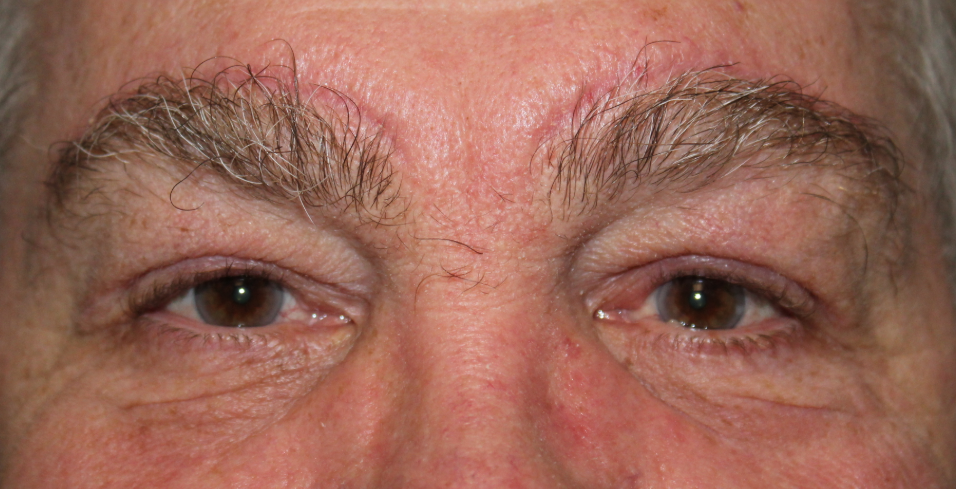 Bilateral Upper Eyelid Blepharoplasty, Bilateral Direct Brow Lift & Bilateral Lower Eyelid Blepharoplasty with Co2 laser (Post-Operative Month 3) After