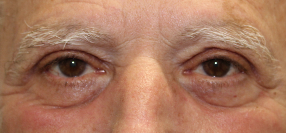 BUL/BLL blepharoplasty (with C02 laser) (Post-Operative Week 1)  After