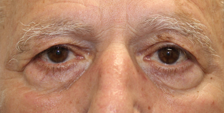 BUL/BLL blepharoplasty (with C02 laser) (Post-Operative Week 1)  Before