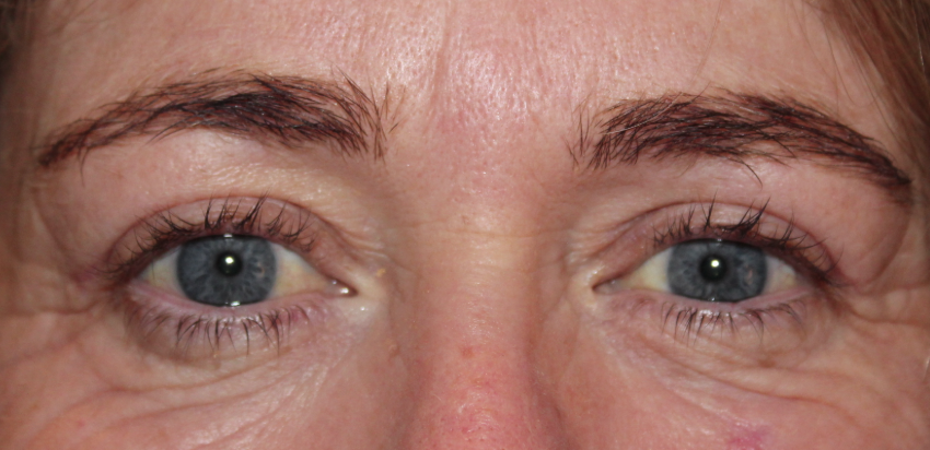 Bilateral Upper Eyelid Blepharoplasty (Postoperative Month 2) After